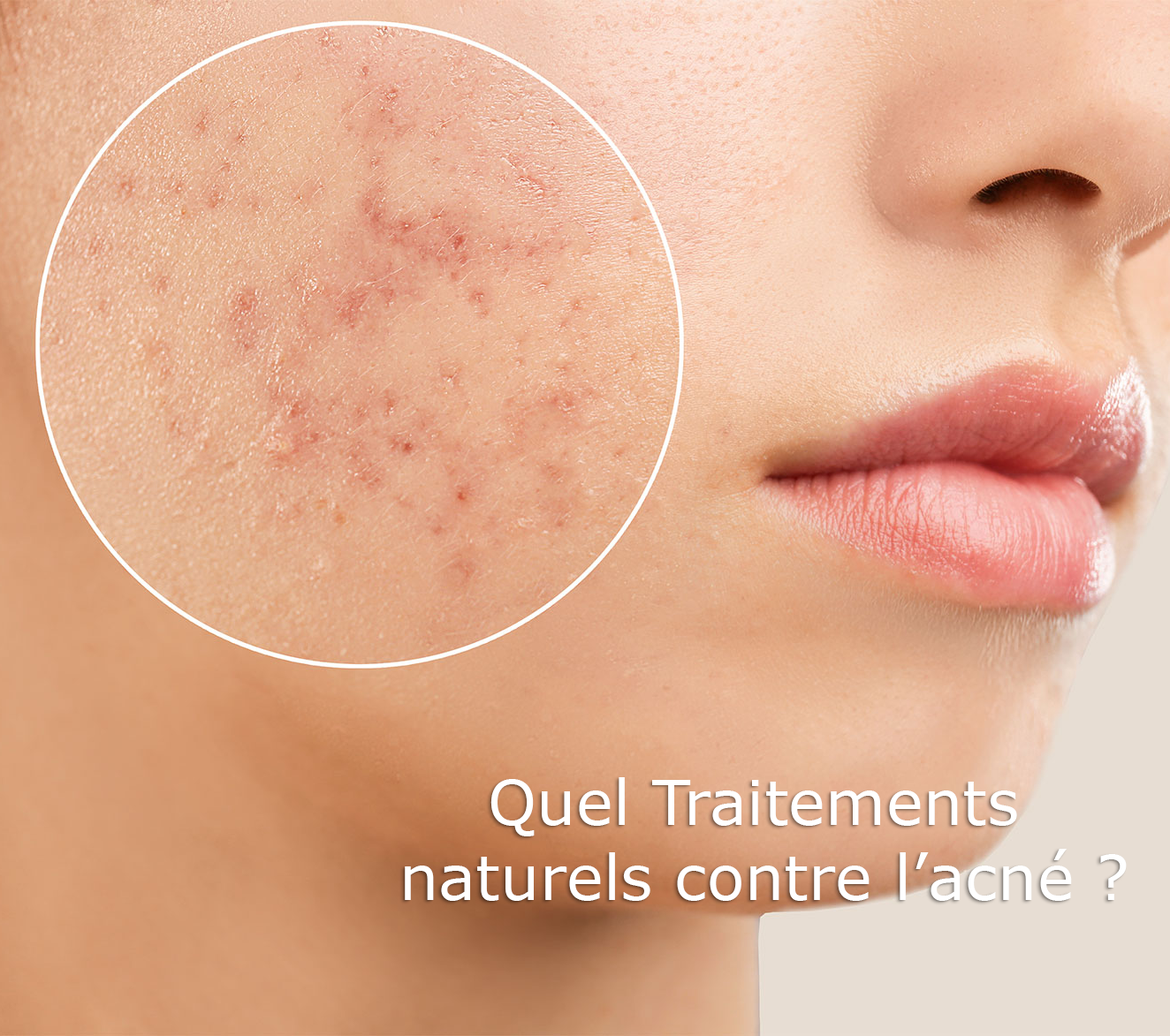 You are currently viewing Traitements naturels efficaces contre l’acné